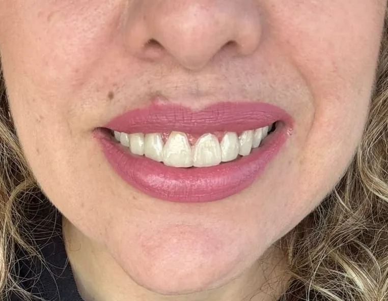 Sonrisa de una paciente real